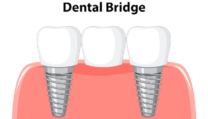 All-on-4 dental implants in Pembroke Pines