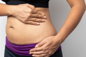 stretch marks cream