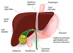 Gall stone surgery