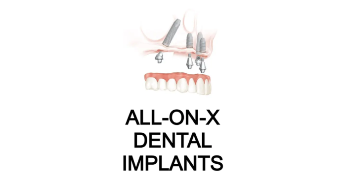 All-on-4 dental implants in Pembroke Pines