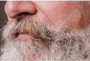 beard transplant in istanbul